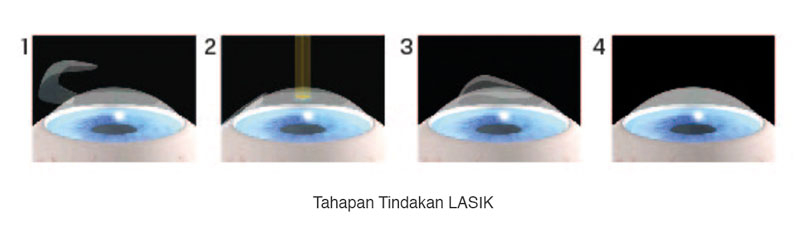 Pengalaman Lasik Mata Dimension Z Lasik Di Jakarta Eye Center Jec