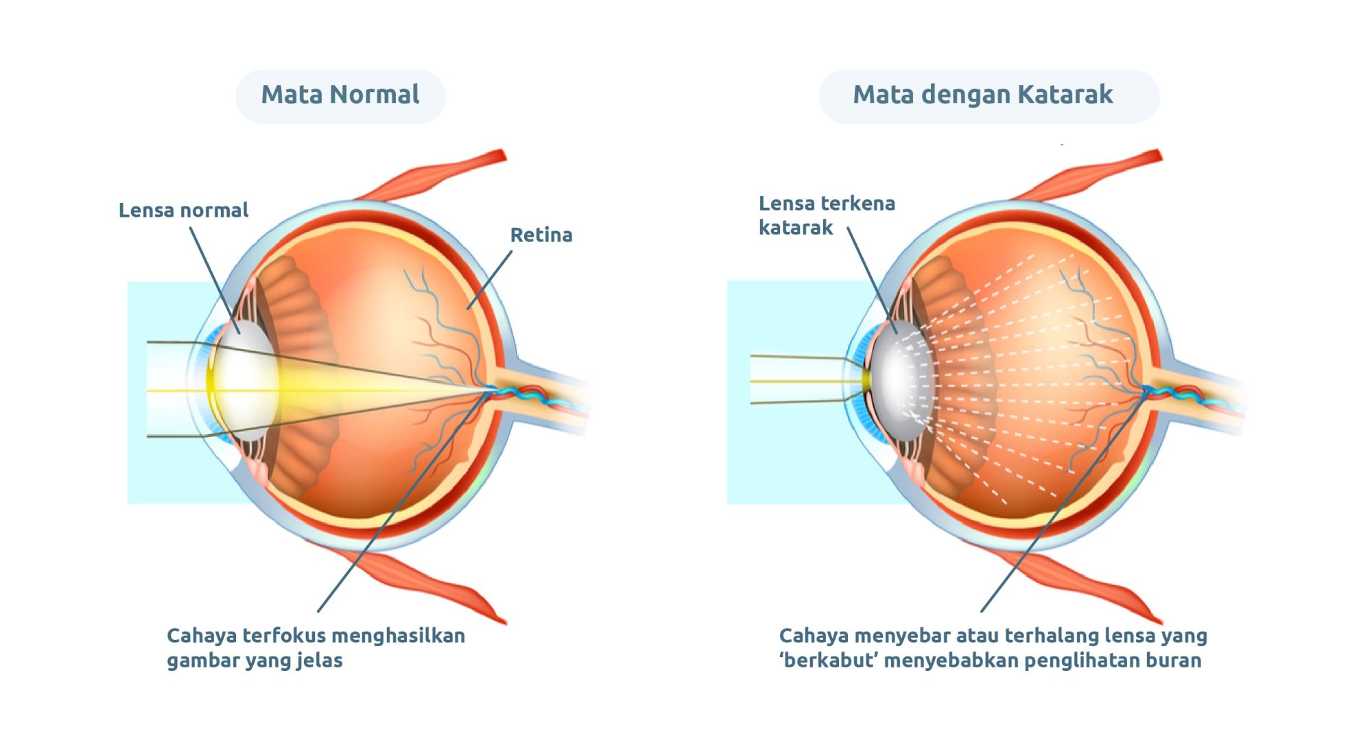 Cataract Rumah Sakit Mata Jec