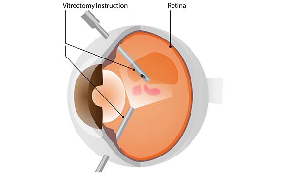 Vitrektomi