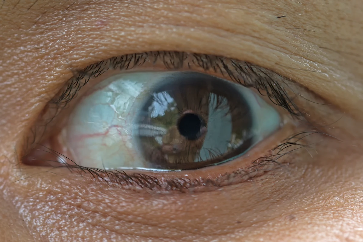 Apa Itu Arkus Kornea Ini Penyebab Dan Cara Menanganinya JEC Eye apa-itu-arkus-kornea-ini-penyebab-dan-cara-menanganinya-jec-eye