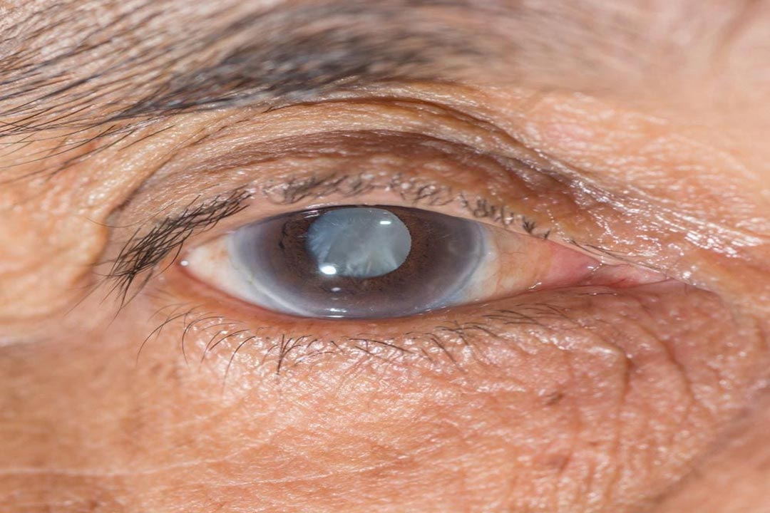Glaucoma : Detection, Treatment and Therapy